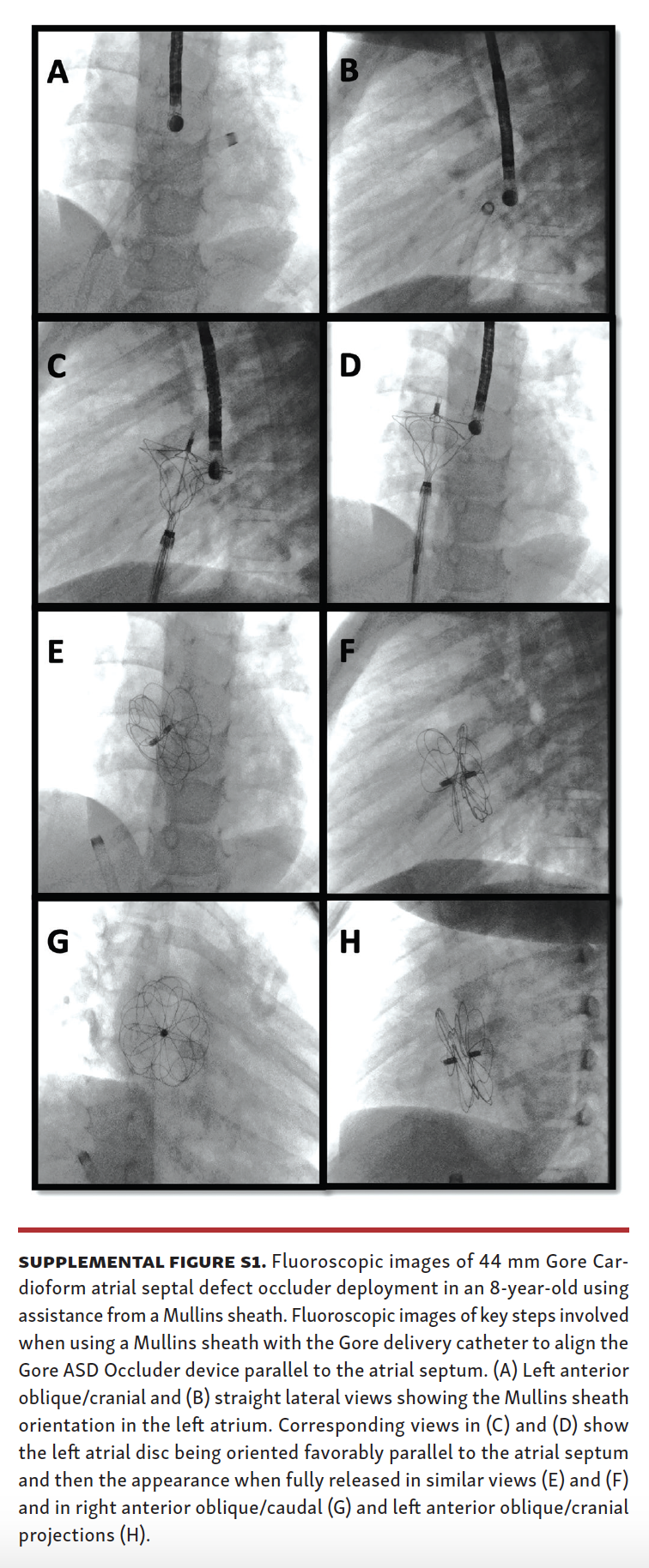 MullinsSheath Facilitated Delivery of Gore Cardioform ASD Occluder